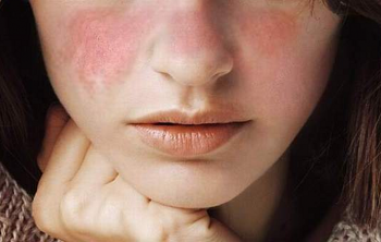 lupus salud