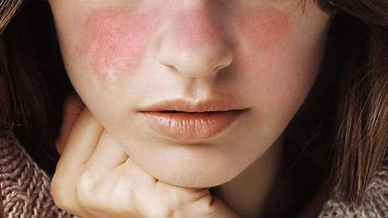 lupus salud