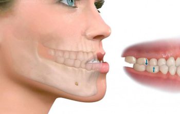 oclusión dental salud