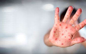 reaparición del sarampión y los riesgos para la salud pública